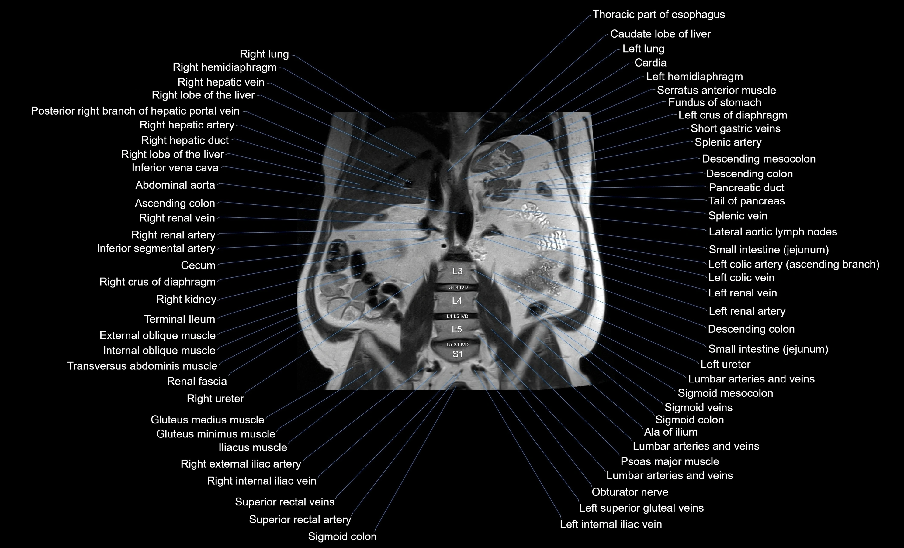 MRI Abdomen coronal labelled cross sectional anatomy radiology  image-img-00001-00034.webp